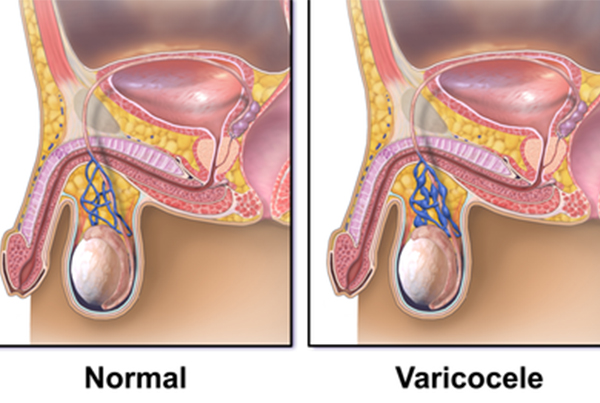 Varicocele