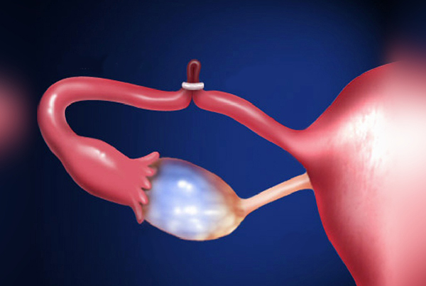 TUBAL LIGATION